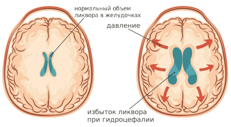 Внутричерепное давление: мифы и реальность